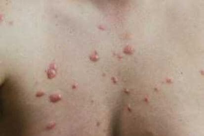 pinnacleskin.com /conditions/keloids Carousel 1 Image 4