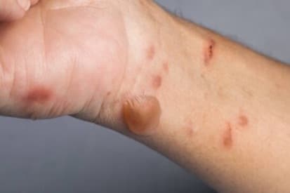 Wilmington Bullous Skin Disorder Example 1