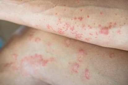 Wilmington Bullous Skin Disorder Example 3