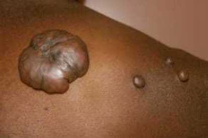 pinnacleskin.com /conditions/keloids Carousel 1 Image 3