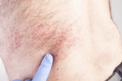 Wilmington Bullous Skin Disorder Example 2