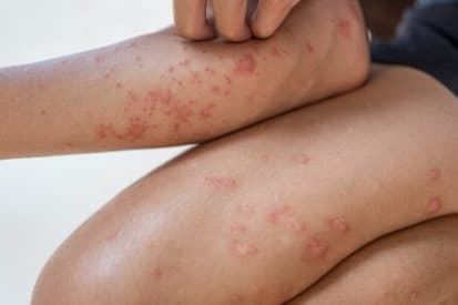 Wilmington Bullous Skin Disorder Example 4