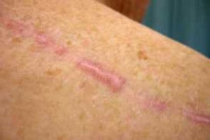 pinnacleskin.com /conditions/keloids Carousel 1 Image 2