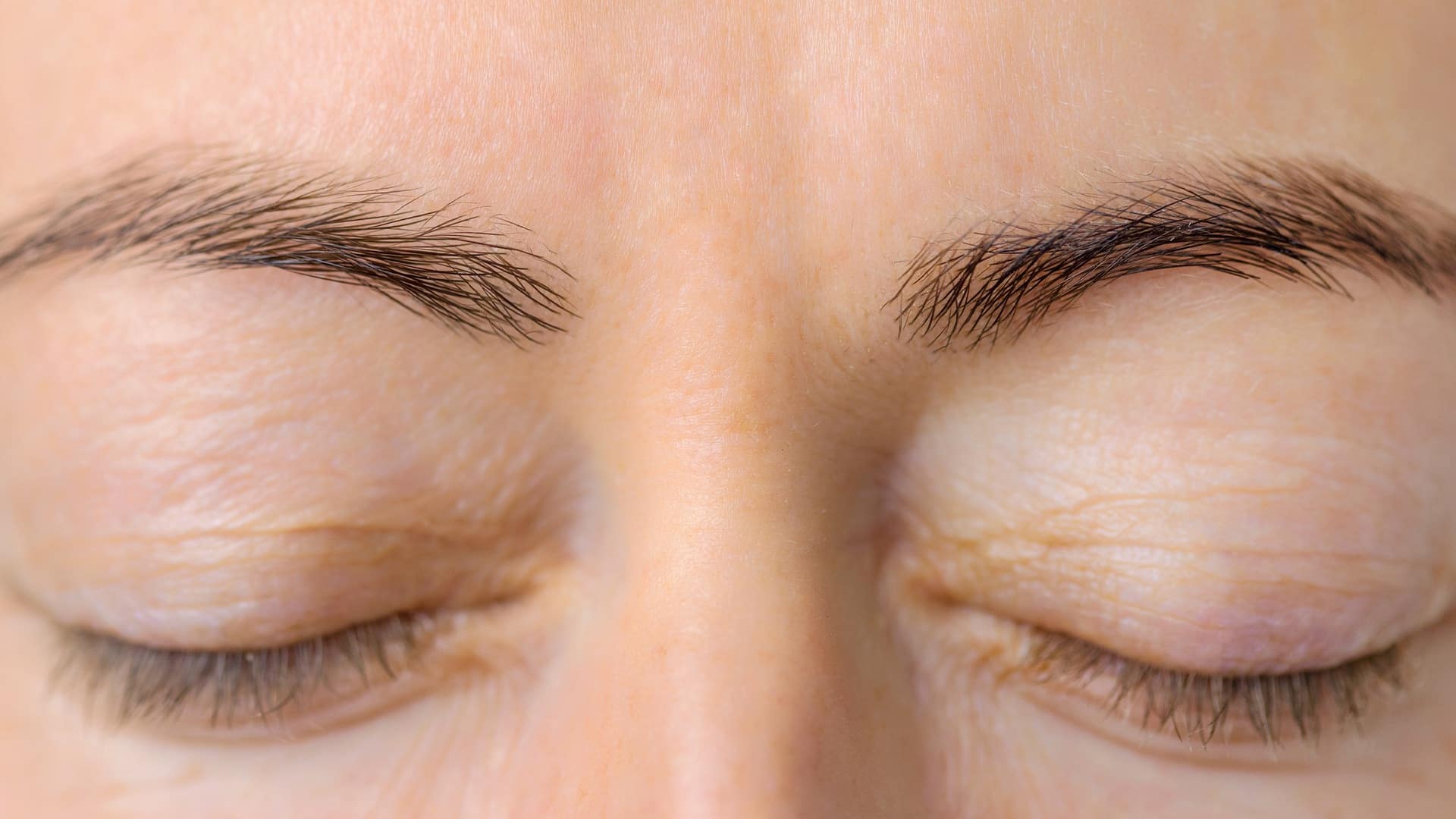 Reduced Brow Line Wrinkles After Dysport Treatment