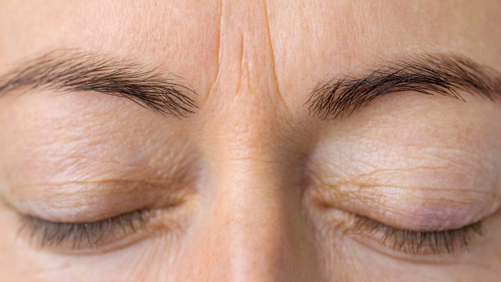 Patient With Brow Line Wrinkles Before Dysport Treatment