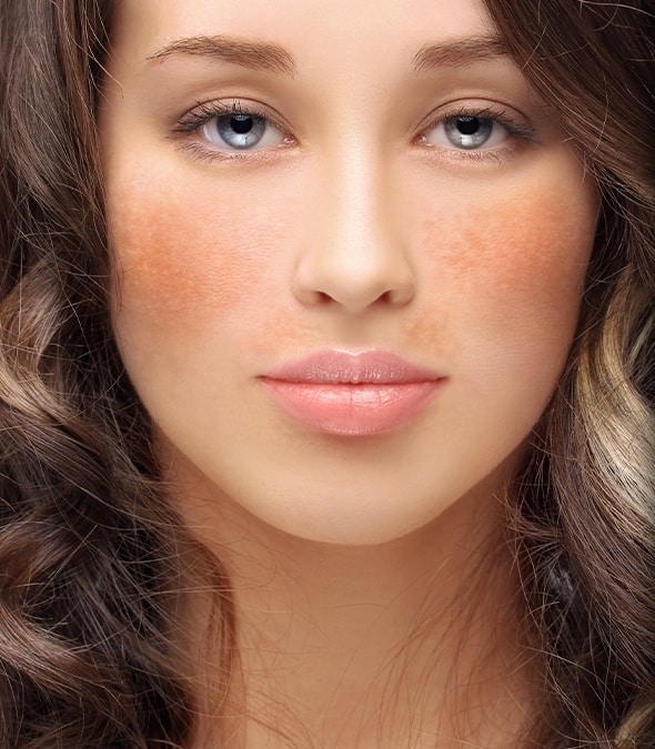 Young woman with hyperpigmentation on her face