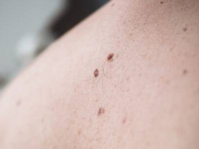 Moles On A Patient's Back