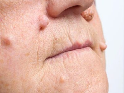 Benign Growths On An Elderly Patient's Face