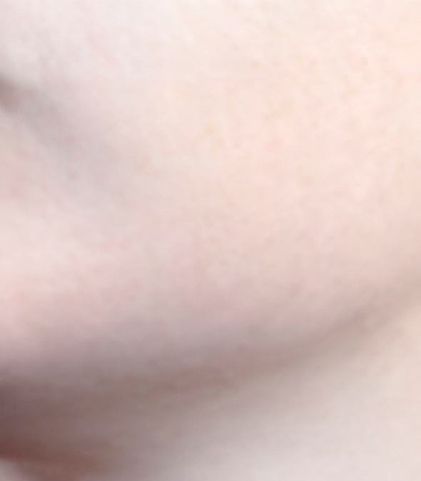 Close Look At A Patient's Chin After Rosacea Treatment