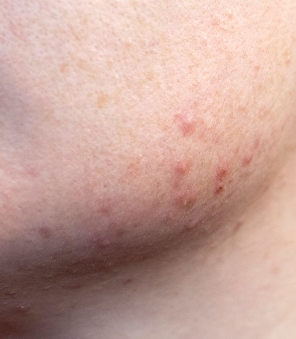 Close Look At Patient's Chin With Rosacea Before Treatment