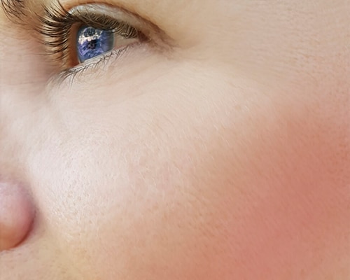 Reduced Crow's Feet And Smile Line Wrinkles Around The Eye Following Dermal Filler Treatment