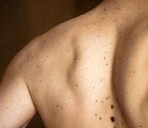 Potential Skin Cancer Lesions On A Patient's Skin