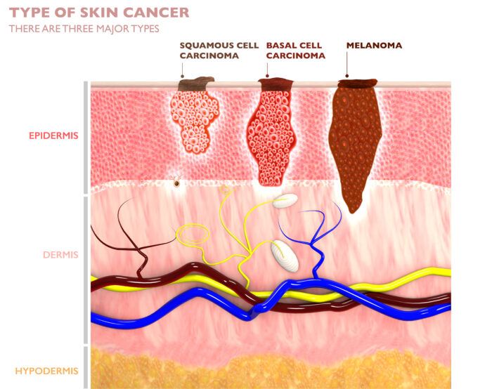 Diagram of the types of skin cancer we diagnose and treat in Wilmington