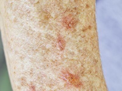 Actinic Keratosis On A Patient's Arm