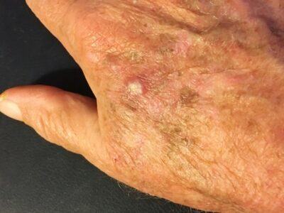 Actinic Keratosis On A Patient's Hand