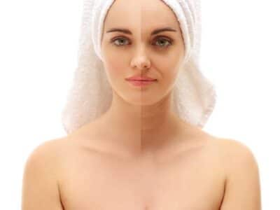 Patient Before And After Chemical Peel Treatment
