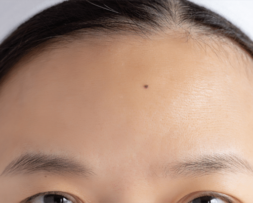 Patient After Receiving Dermal Filler Treatment For Forehead Wrinkles