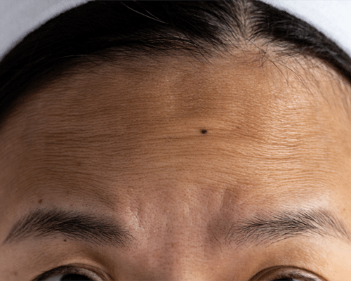 Wrinkles On A Patient's Forehead Before Dermal Filler Treatment