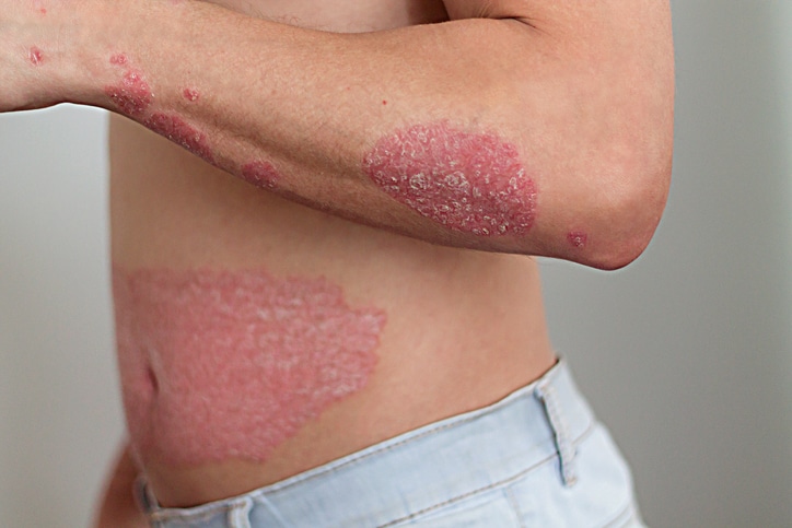 Psoriasis Affecting A Person's Arm And Abdomen