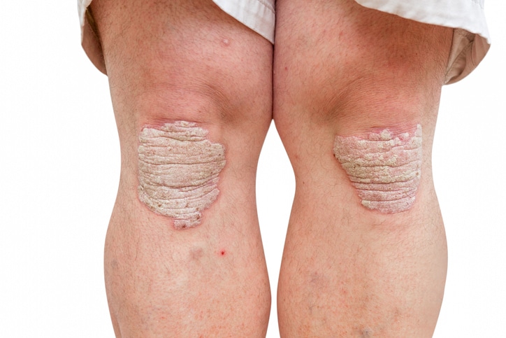 Psoriasis On A Patient's Knees