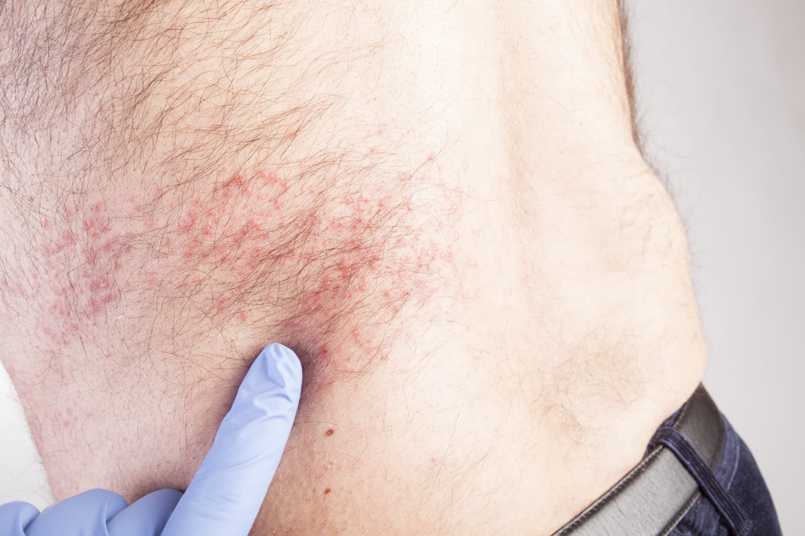 Eczema, Or Atopic Dermatitis, On A Patient's Abdomen