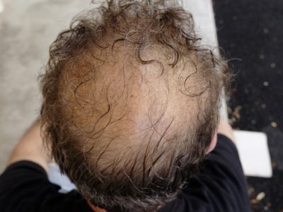 A Patient Experiencing Extensive Hair Loss On Their Head