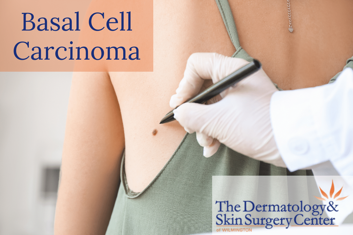 A Board-certified Dermatologist At The Dermatology & Skin Surgery Center Of Wilmington Examining A Patient’s Skin For Basal Cell Carcinoma.