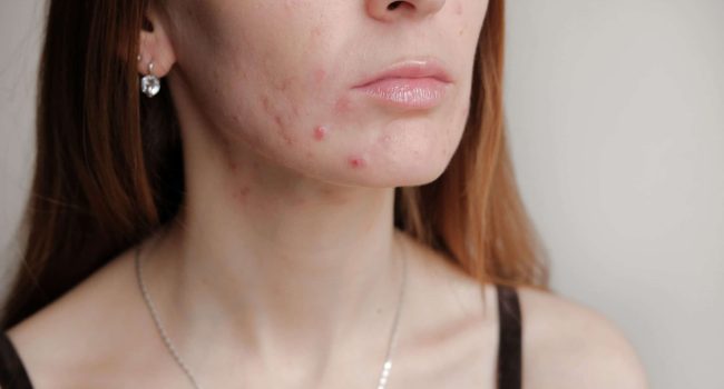Acne On Someone's Chin And Neck Prior To Treatment