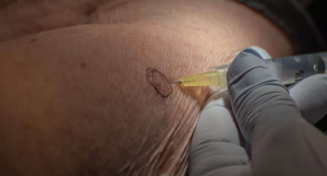 Skin Cancer Surgical Excision Procedure Performed By A Board-certified Dermatologist