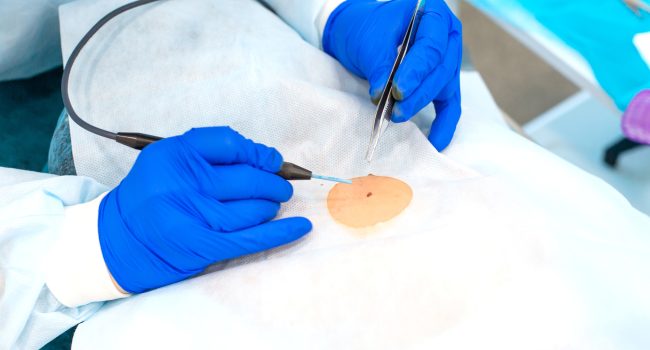 Board-certified Dermatologist Performing A Mole Removal Procedure