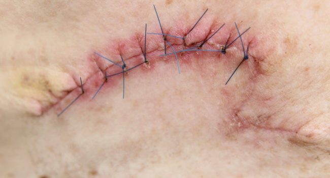 Surgical Excision Site Closed With Sutures
