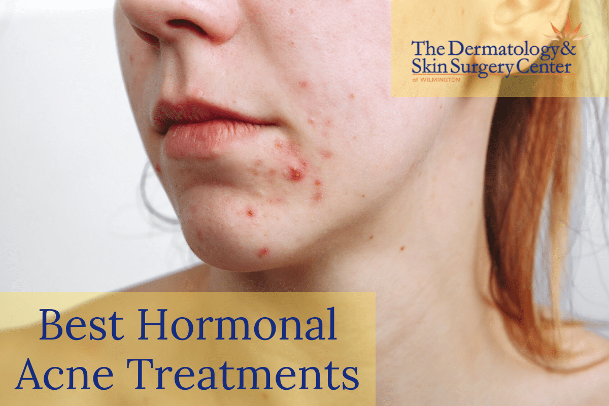 Woman With Hormonal Acne Searching For The Best Hormonal Acne Treatments In Wilmington, NC