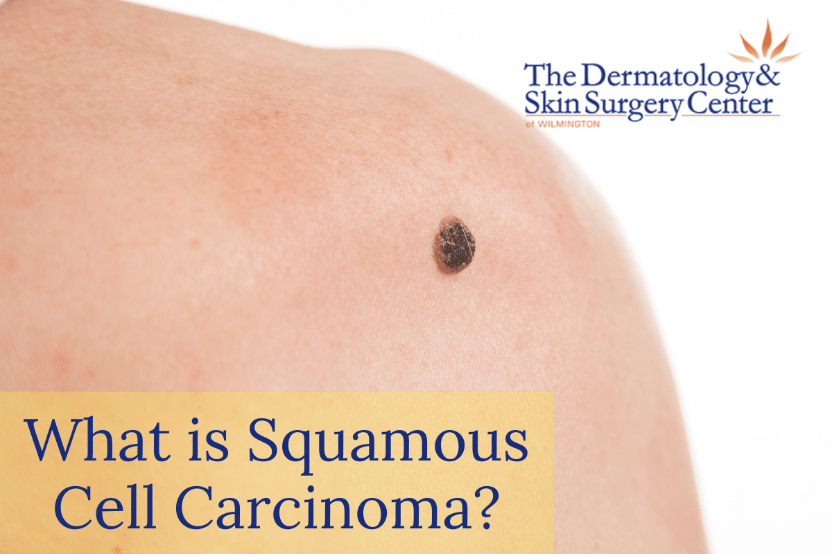 What Is Squamous Cell Carcinoma? | The Dermatology & Skin Surgery Center Of Wilmington | Wilmington, North Carolina
